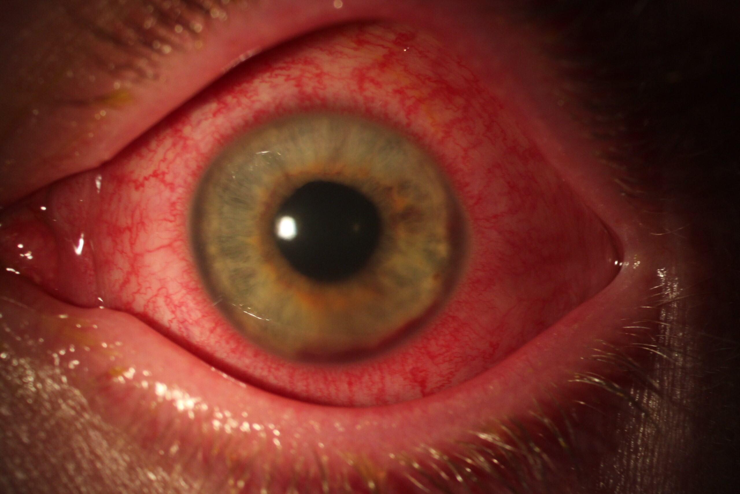 Uveitis